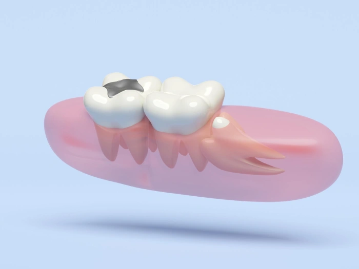 wisdom tooth extraction clyde north