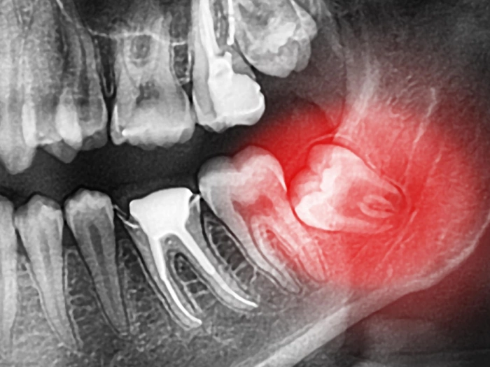 wisdom tooth extraction clyde north