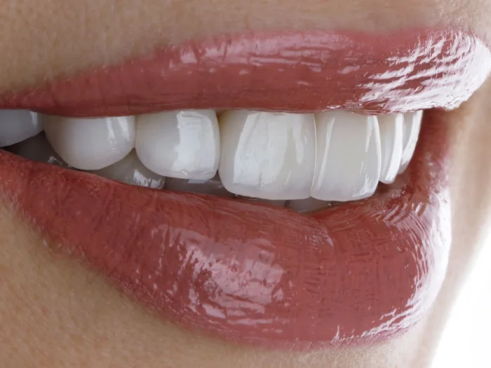 composite veneers cost clyde