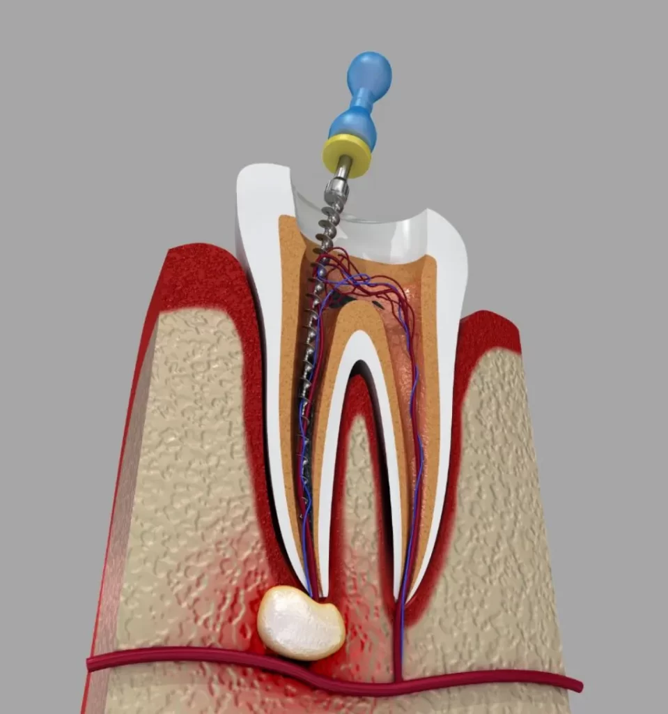 Root Canal Treatment Clyde North