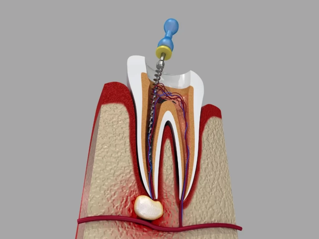 Root Canal Treatment clyde north