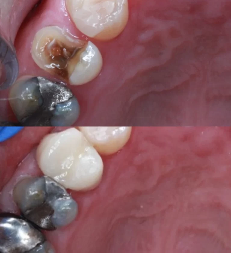 Before and after dental treatment result 20