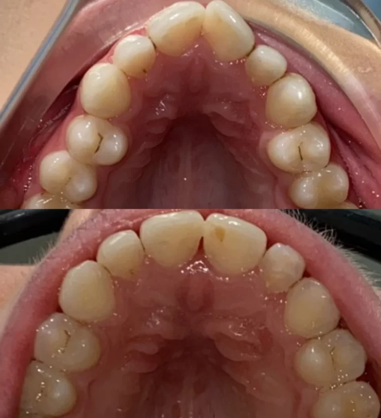Before and after dental treatment result 17
