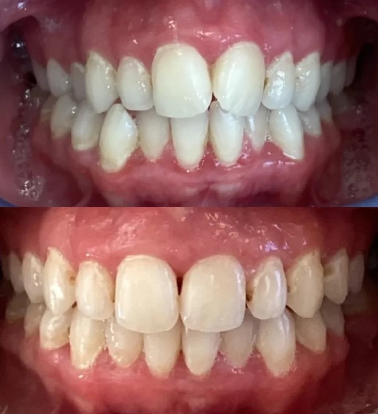 Before and after dental treatment result 16
