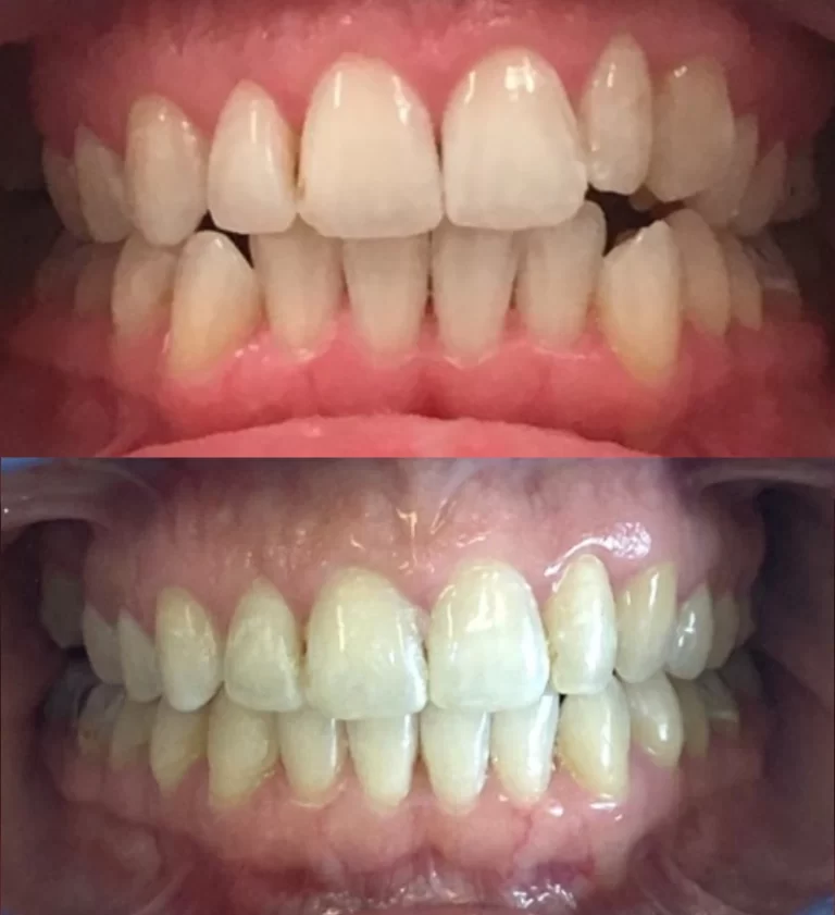 Before and after dental treatment result 18
