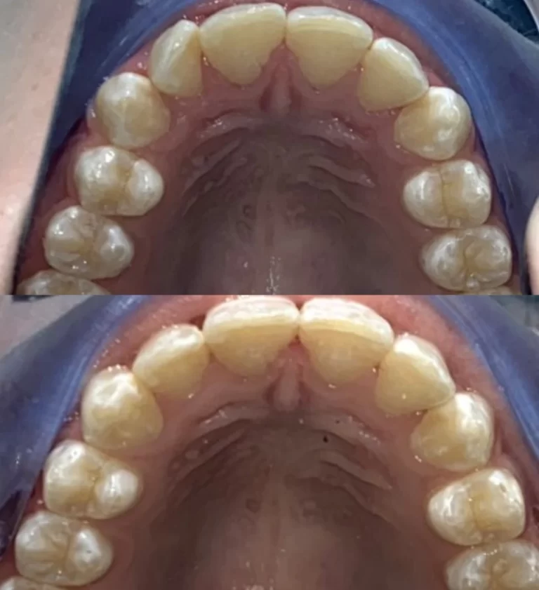 Before and after dental treatment result 11