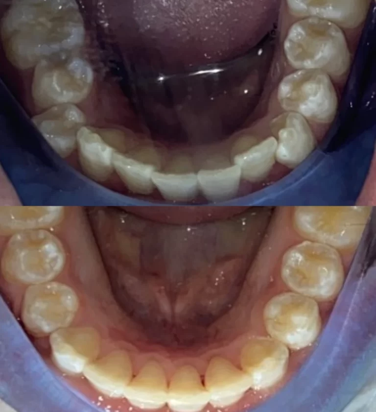 Before and after dental treatment result 12
