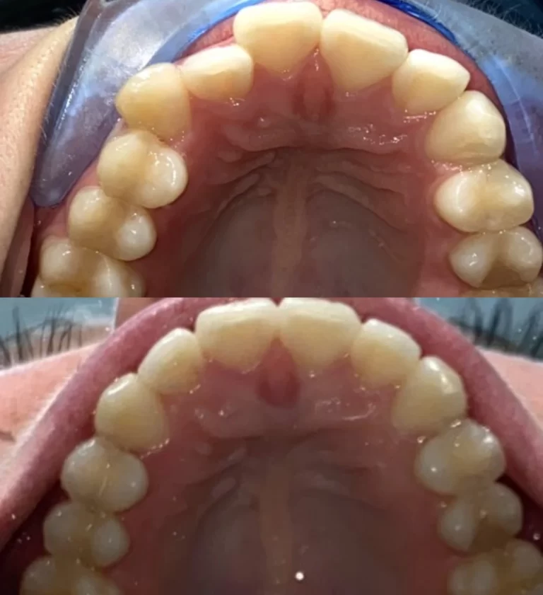 Before and after dental treatment result 2