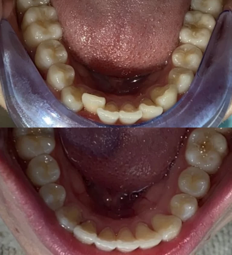 Before and after dental treatment result 3