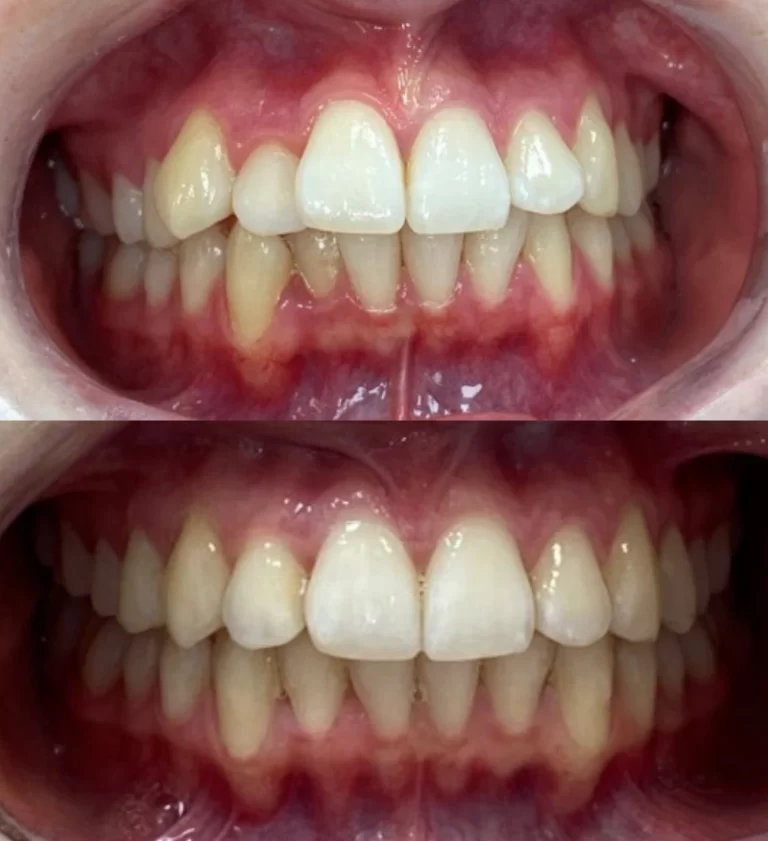 Before and after dental treatment result 1