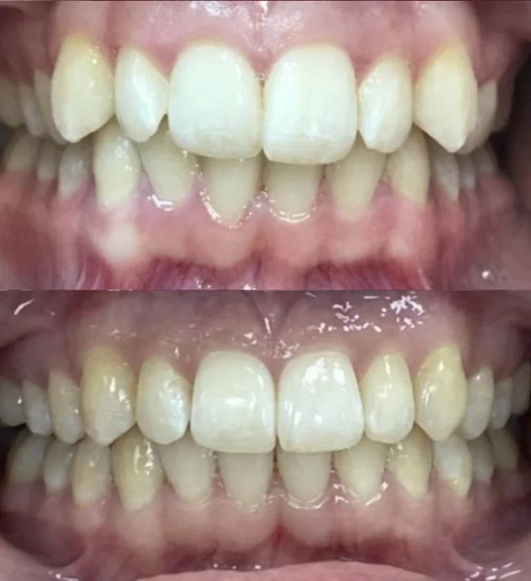 Before and after dental treatment result 4