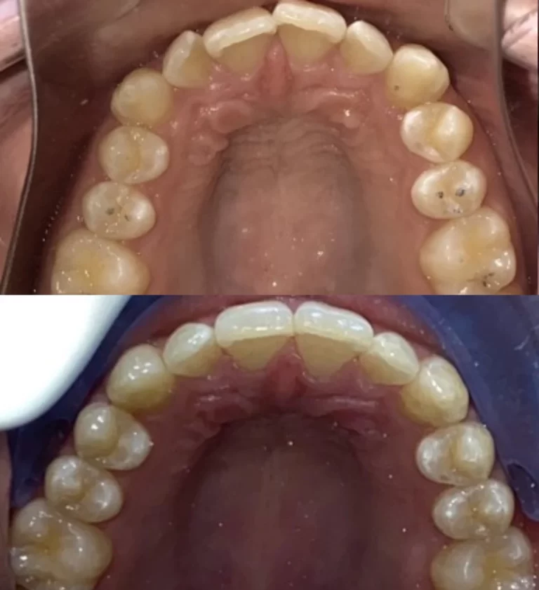 Before and after dental treatment result 5