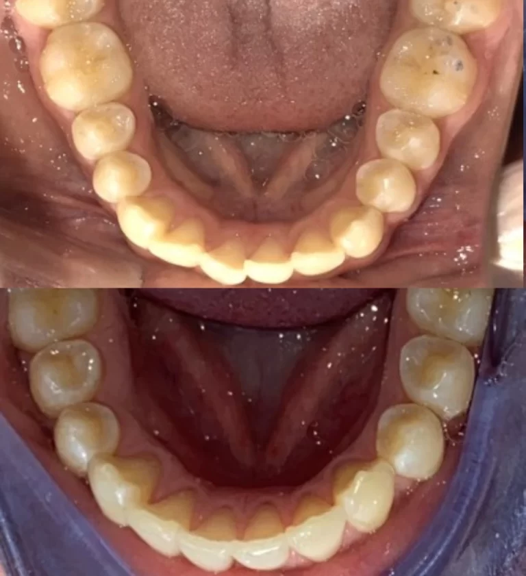 Before and after dental treatment result 6