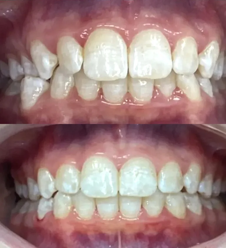 Before and after dental treatment result 10
