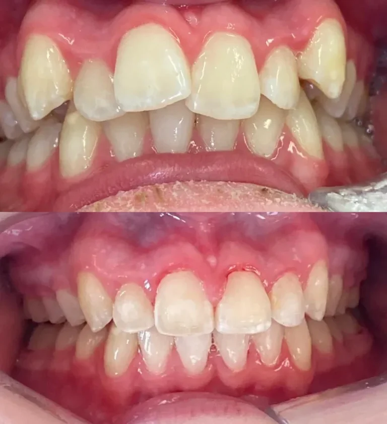 Before and after dental treatment result 21