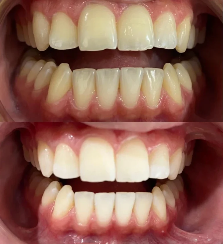 Before and after dental treatment result 24