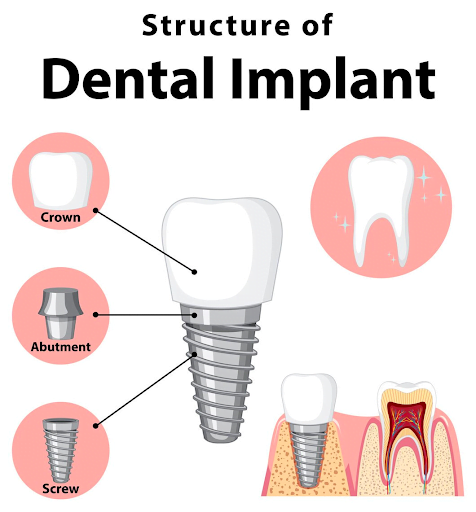 dental implant structure