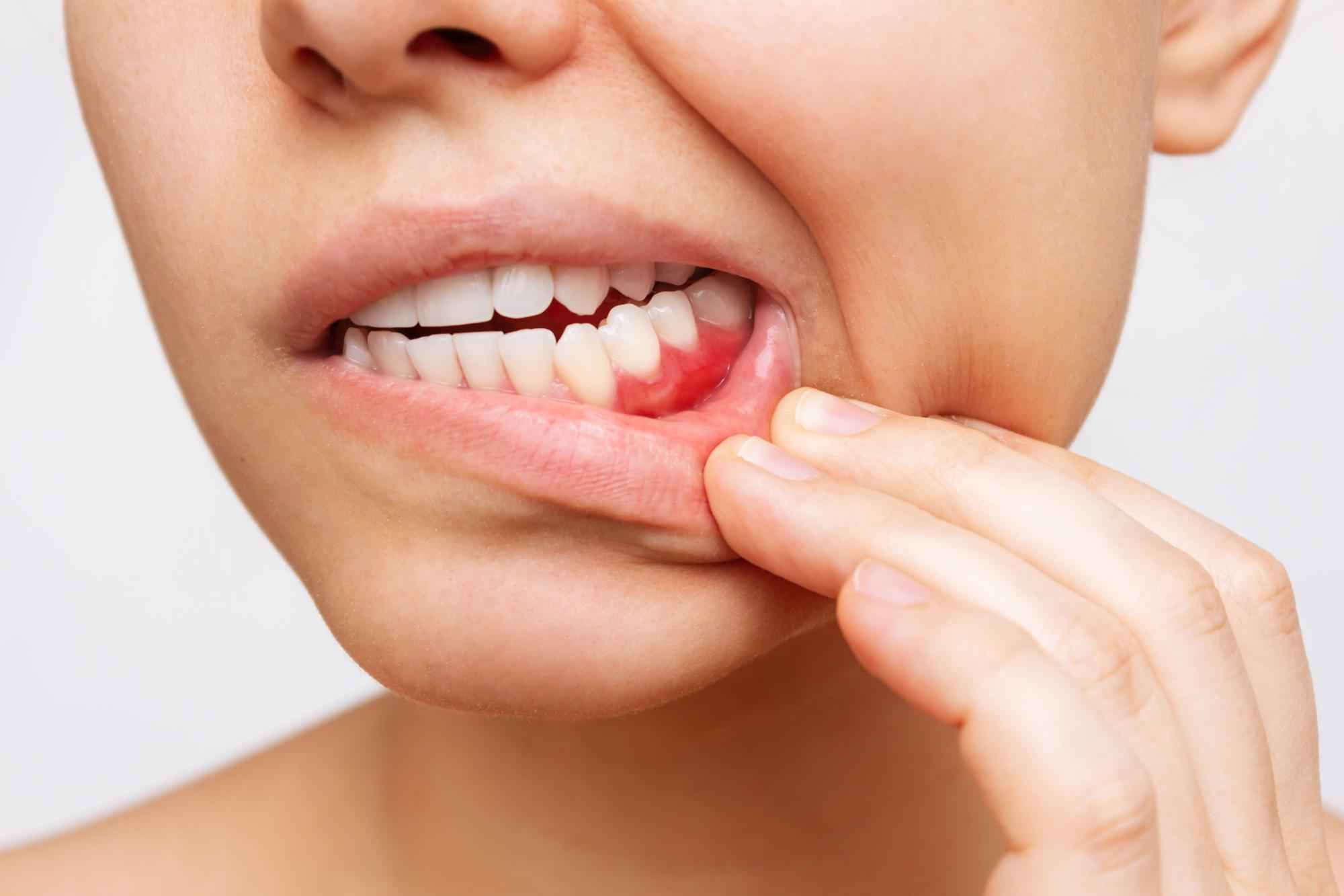 Gum disease treatment