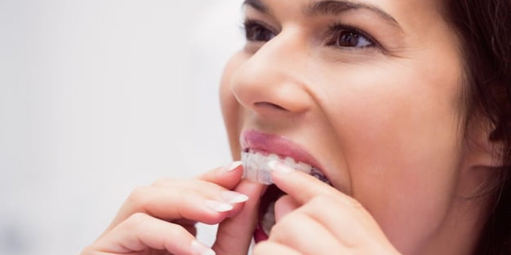 Clyde North Dental- Clear Aligner