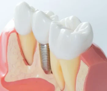 dental implants clyde north