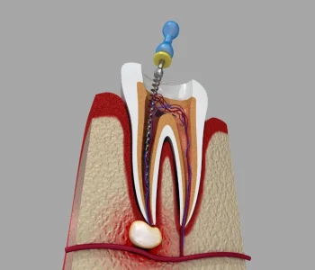 Root Canal Treatment clyde north