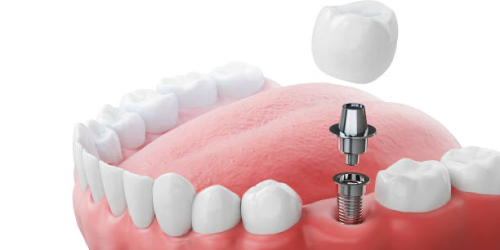 Dental Implants